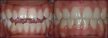 Orthodontic before and after