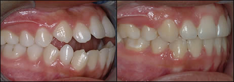 Orthodontic before and after