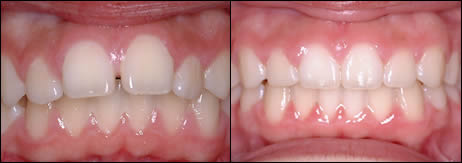 Orthodontic before and after