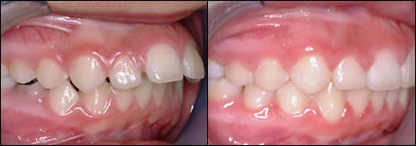 Orthodontic before and after