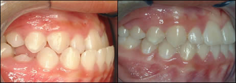 Orthodontic before and after